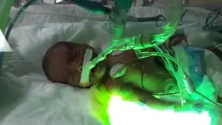 My micro preemie miracle