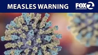 Bay Area health officials warn of possible measles exposure | KTVU