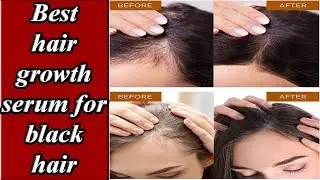 5 Best hair growth serum for black hair