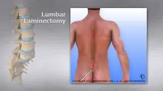 Lumbar   Laminectomy