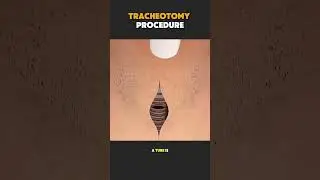 How a Tracheotomy Saves Lives 🫁! #facts #knowledge  #interestingfacts  #interesting  #shorts