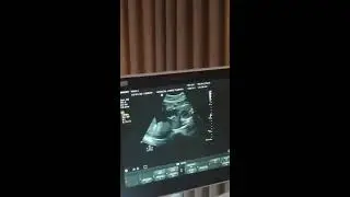 27 Haftalık hamilelik 3d ultrason 27 weeks pregnant 3d ultrasound