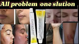 Contractubex Gel for remove fire stain acni scar stiches stain remove @storiesbyrubab