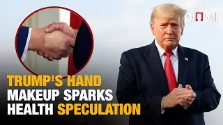 Trump's Makeup-Covered Hand at Zelenskyy Meeting Fuels Health Speculation on Social Media