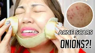 Get Rid of ACNE SCARS with ONIONS!