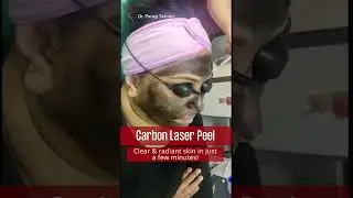 Clear & Radiant Skin in Just a Few Minutes with Carbon Laser Peel Treatment |#laserfacial #shorts