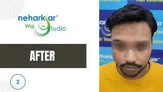 Hair replacement in Mumbai | Mulund | Non surgical |hair bonding | Hair fixing | Hair patch |