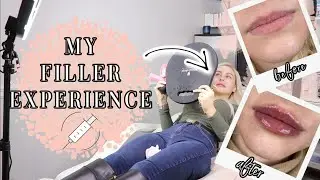 MY FILLER EXPERIENCE&hellip;WHAT YOU NEED TO KNOW BEFORE!
