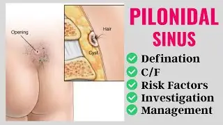 Pilonidal Sinus(Cyst)|Risk factors|Clinical features|Investigation|Management|