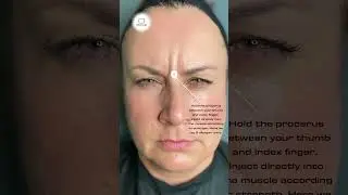 BOTOX FOR FROWN LINES 💉