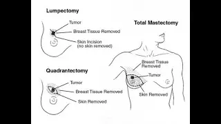Mastectomy surgical procedure to remove one or both breasts ; Types, Indications, Procedure, Uses
