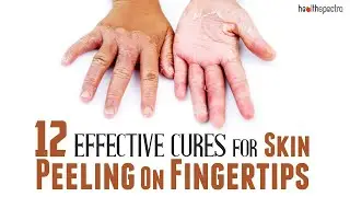 12 Effective Cures For Skin Peeling On Fingertips | Healthspectra