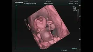 ABC Zwangerschap 13 Weken 3D Live Echofilmpje