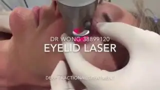Fotona Smooth Eye Treatment for Eyelid Rejuvenation (Brisbane)