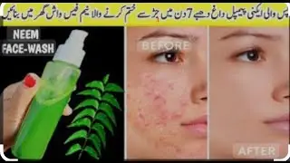 Neem Face Wash,Toner,Ice Cube Remedy||Neem Benefits For Skin ||Anti-Acne