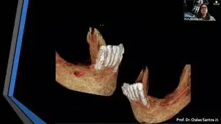 Laudo de Tomografia para Implantes - Webinar Anne Solutions