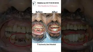 From UK (London) to OroFace Mumbai Dental Implant Treatment Story