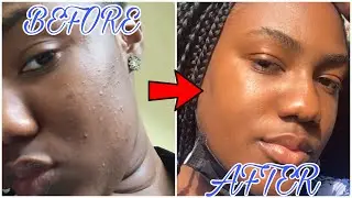 Clear skin in a month - Toria Junie's step by step guide