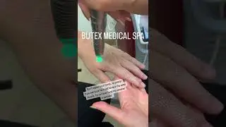 Laser Hand Rejuvenation improves skin quality by enhancing skin tone and surface texture.