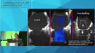 CVI2018 Session: Is transcatheter therapy innovation necessary? - David Rizik, MD