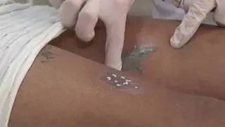 Técnica promete remover tatuagem e dá esperanças para quem se arrepende