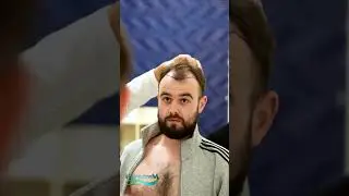 HairextreM | Hair transplant journey #hairtransplant #greffedecheveux #hairextrem