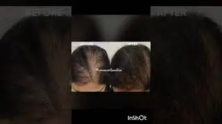 Say Goodbye to Unwanted Hair | Laser Hair Reduction Explained!#LaserHairReduction #SmoothSkinGoals