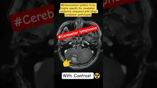 #Diffusion and Contrast Enhancement Patterns of Cerebellar Lymphoma on MRI#shortvideo