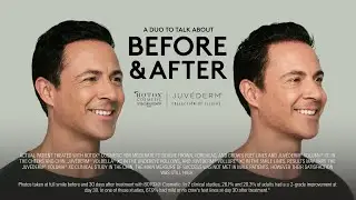 Justin&rsquo;s Before & After Treatment With BOTOX&reg; Cosmetic & the JUV&Eacute;DERM&reg; Collection of Fillers
