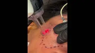 TCA CROSS, Subcision, and C02 Laser for ACNE SCARS