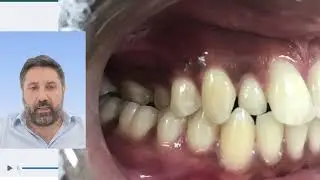 🇮🇹 Incisivo laterale mancante: soluzione con allineatori e impianto dentale