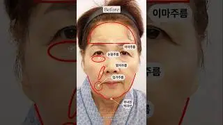 시간을⌛ 되돌리는 놀라운 거상수술 후기