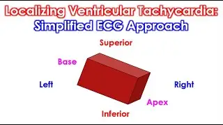 Localizing Ventricular Tachycardia: Simplified ECG Approach