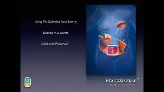 Procedure At-a-Glance: Stacked Flap℠ Reconstruction - Center for Restorative Breast Surgery