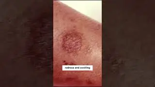 Is a Joro Spider Bite Poisonous? #shorts #spiderfacts #shortvideos #animalshorts #shortsviral