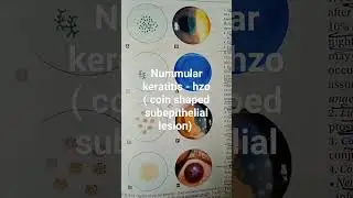 hzo - zoster keratitis