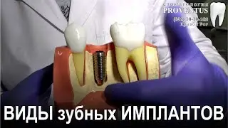 Импланты зубов: виды и какие применяют в клинике Провентус, Кривой Рог, Украина