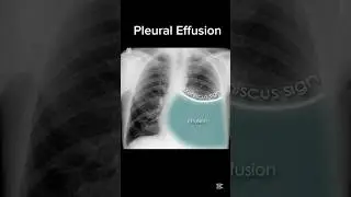 Chest Radio finding 🩻🩺🧑&zwj;⚕️ #chest #doctor #usmle #usmleprep #usmlesteps