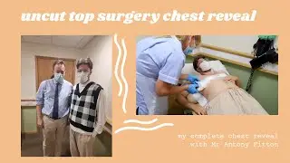 top surgery reveal with Mr Antony Fitton || FTM trans