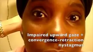 Reel-Example: Parinaud's Syndrome 2 - Convergence-retraction nystagmus