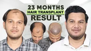 Hair Transplant in Delhi (HX-KKJN) | Best Results & Cost of Hair Transplant in Delhi.