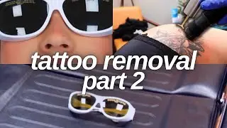 Fading Heavy Dark Ink | Tattoo Removal Part 2