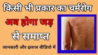 किसी भी प्रकार का चर्मरोग अब होगा जड़ से समाप्त#modicare dtox#modicare tea tree oil#multivitamin