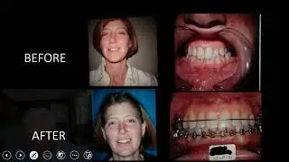 Botched Case Repair - Using Reverse Headgear, Upper Lip Bumper and Space Opening