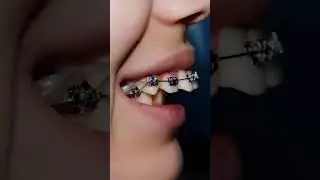 power of Braises | teeth alignment | Braises