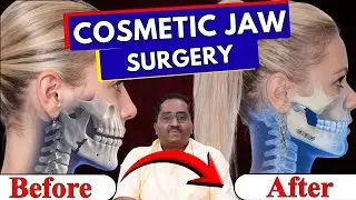 Cosmetic Jaw Surgery: Boost Confidence & Function!