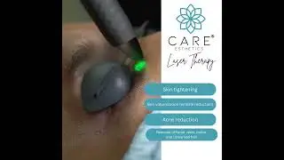 Benefits of Fotona Laser Therapy | CARE Esthetics