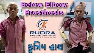 કુત્રિમ હાથ Below Elbow Prosthesis #artificialhand #advanceprosthesis #prosthesis #artificiallimb