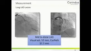 Robotic PCI - Manish Parikh, MD