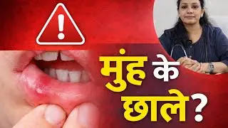 Homeopathy for Mouth Ulcers | Best Medicines & Diet Tips
